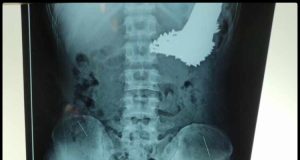 Xray